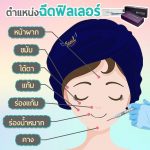 ตำแหน่งของการฉีด Filler สามารถฉีดบริเวณไหนได้บ้าง?